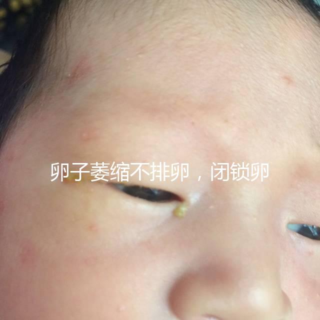 卵子萎縮不排卵，閉鎖卵泡形成原因與這4點有關(guān)