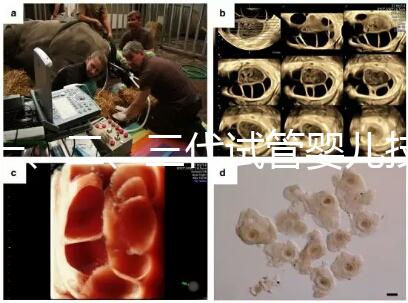 一、二、三代試管嬰兒技術的區別，看完你就知道了！