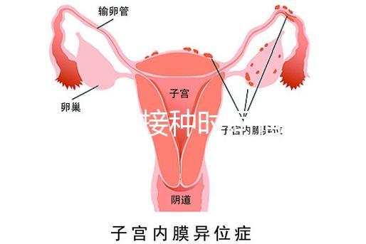 麻疹疫苗接種時間指南，初種年齡最好不要晚于這個月齡